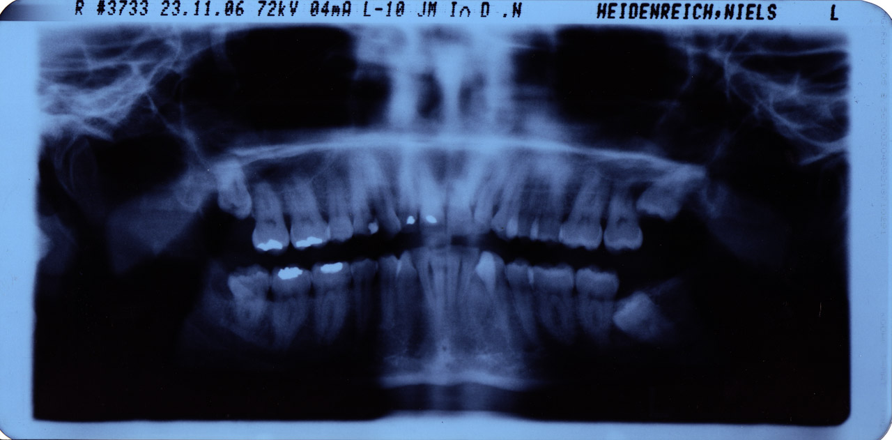 Inlays and Onlays Dental Restoration