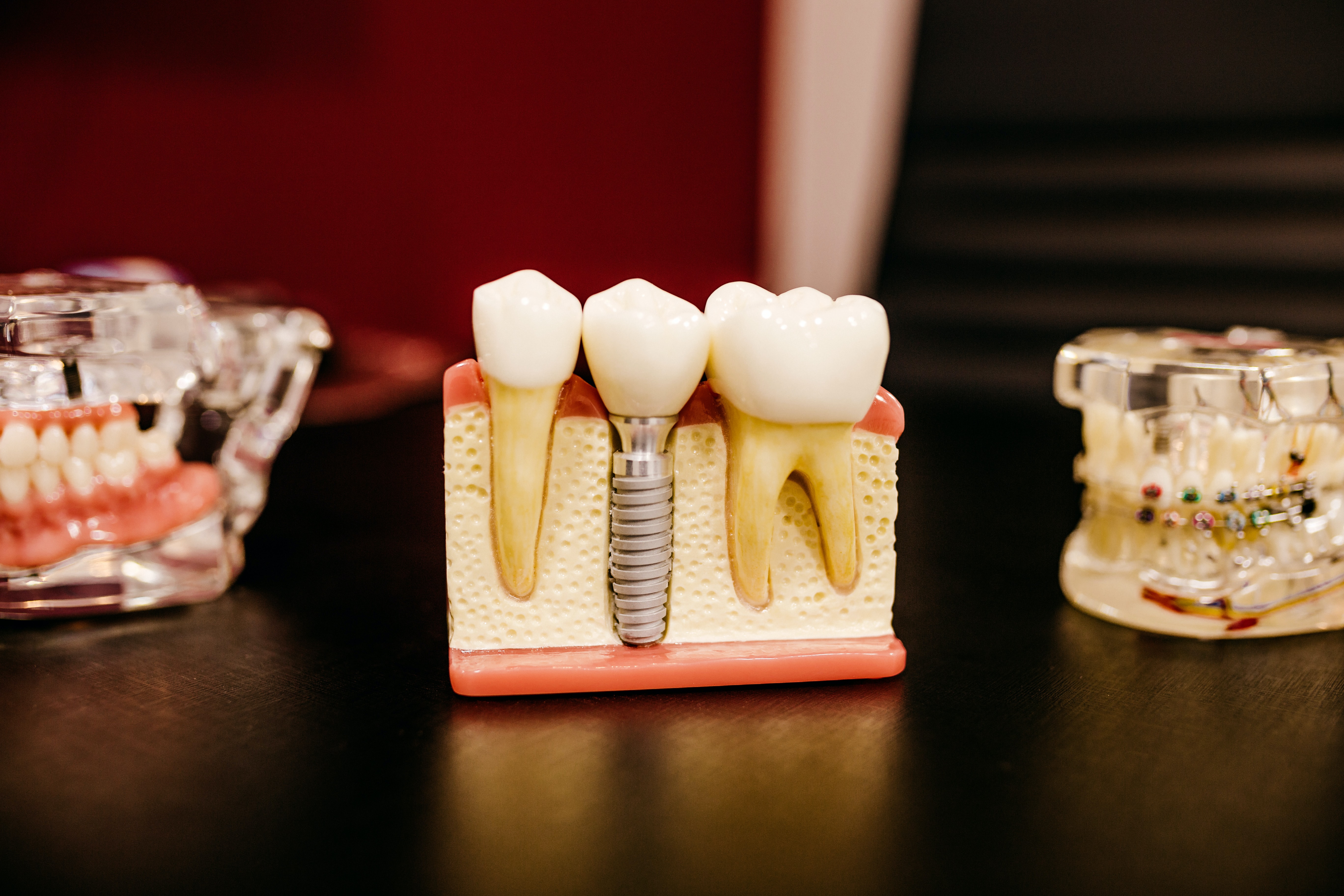 missing teeth problems - stand showing different examples of teeth and implants