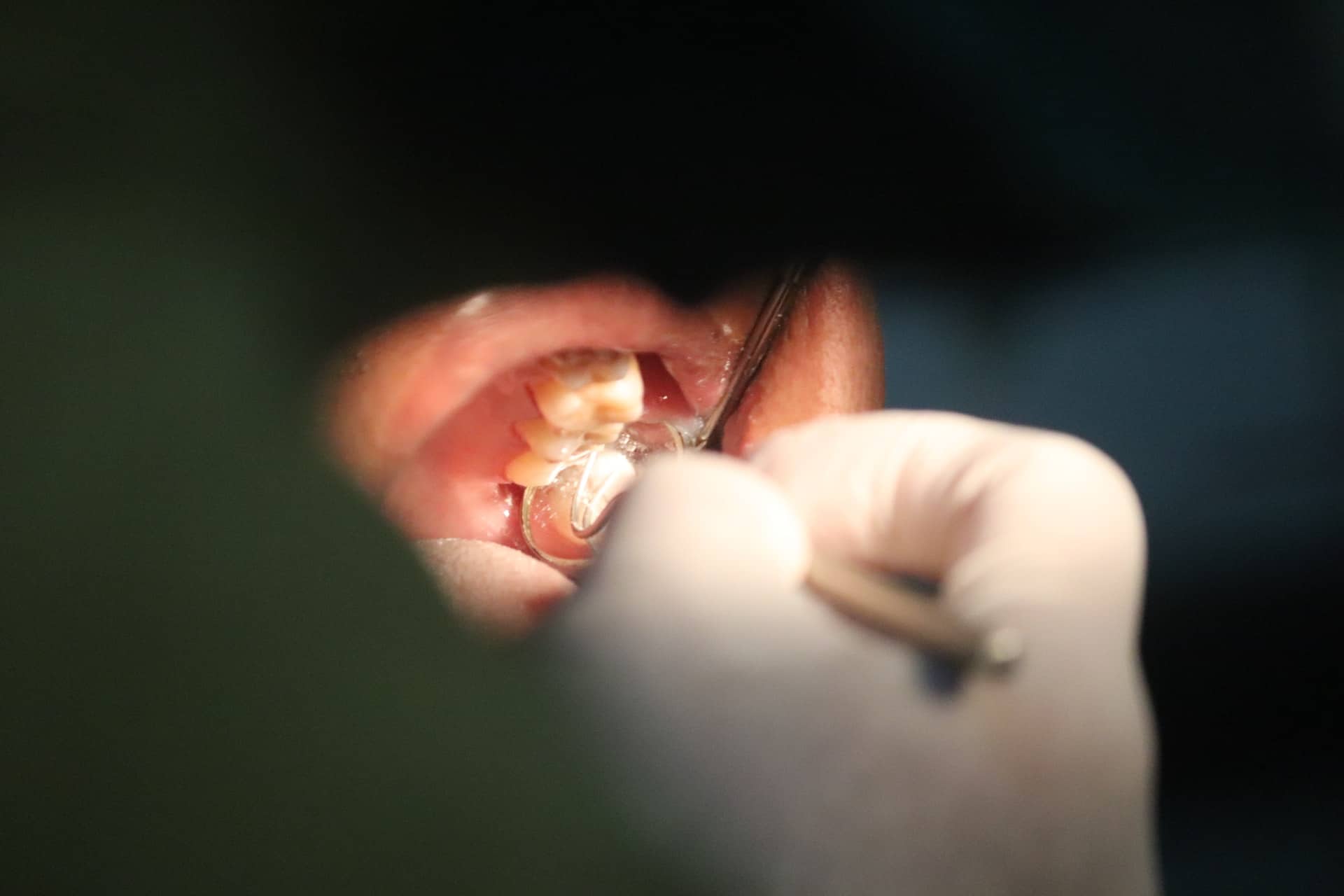 Composite fillings - patient having teeth examined by dentist, checking for cavities.