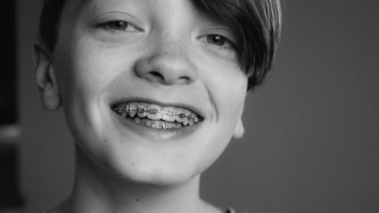 teeth straightening - girl smiling with braces on.