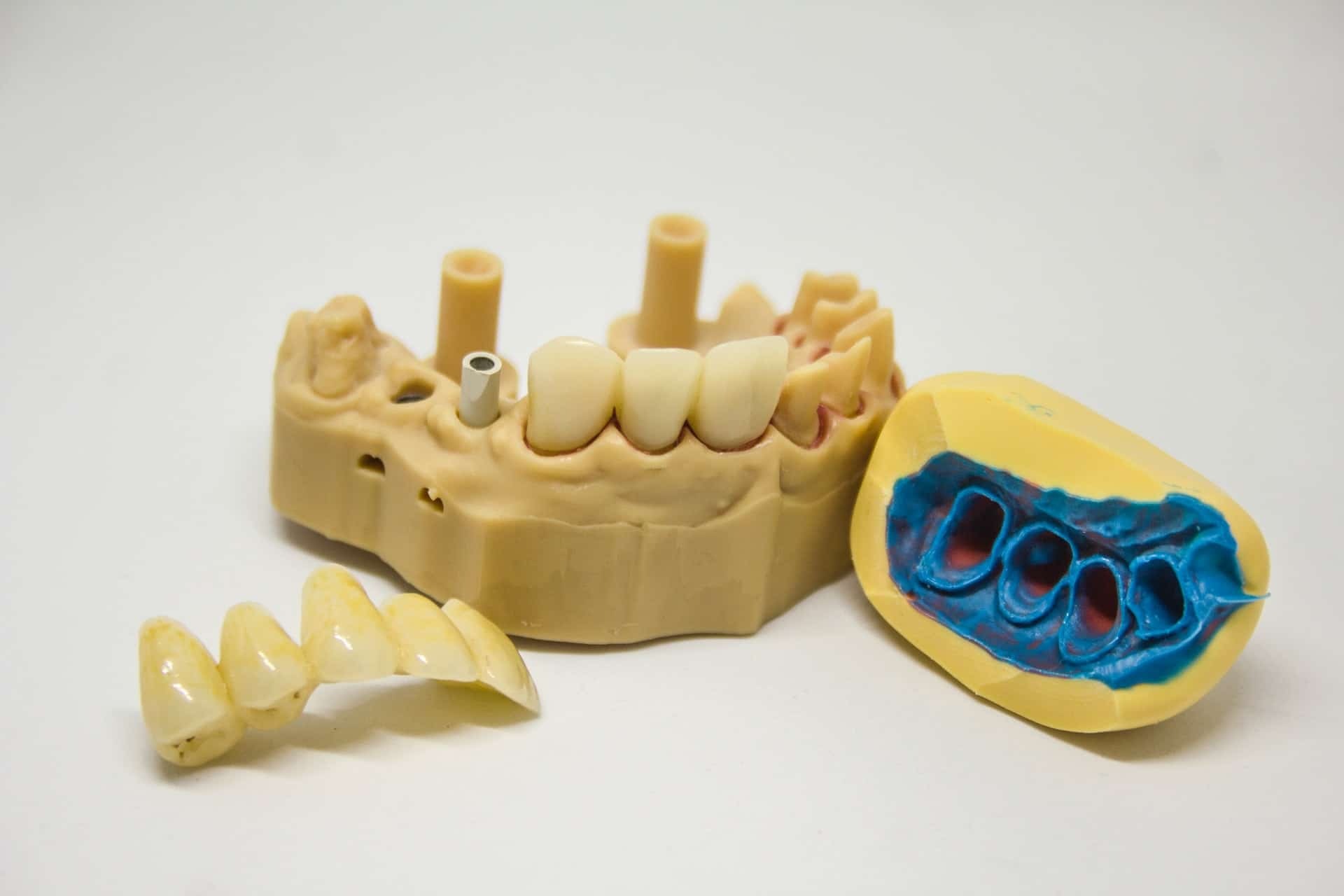 tooth extraction - model of the lower jaw and tooth extraction example