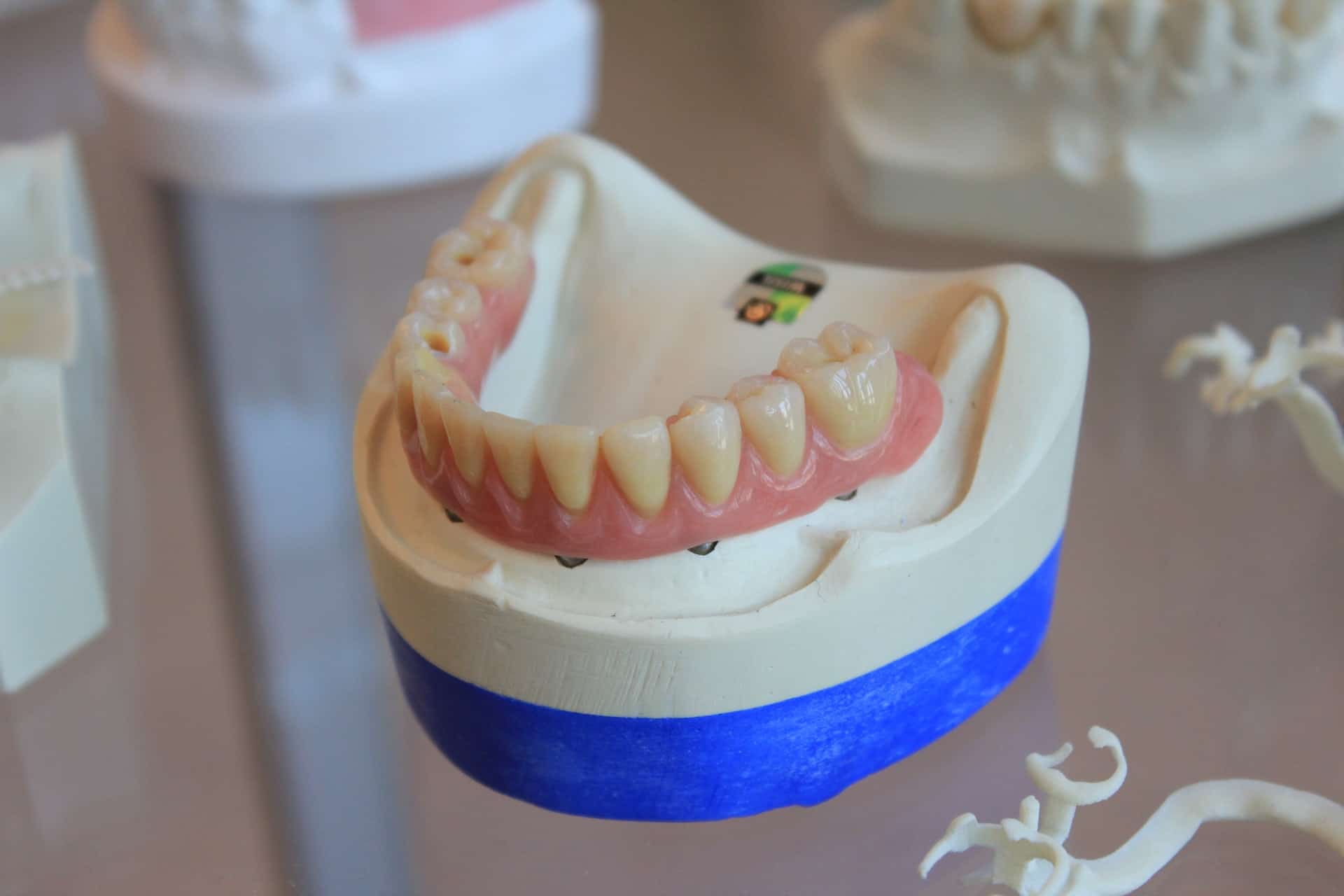 rheumatoid arthritis - model of teeth and gums