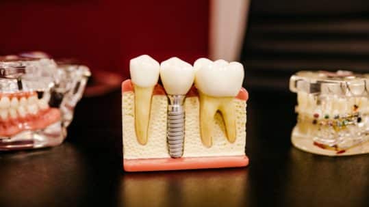How Long Do Dental Implants Last - dental implant model