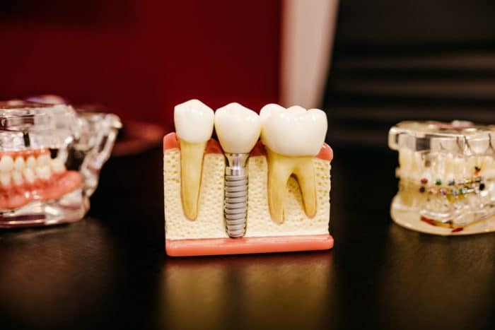 How Long Do Dental Implants Last - dental implant model