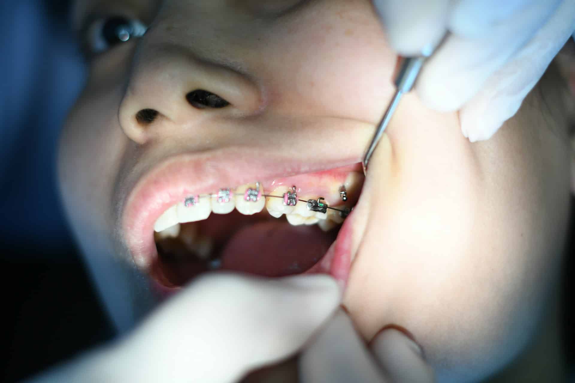 If food gets trapped in your braces, it can cause cavities. You will have to pay extra attention to your brushing and flossing and be careful of the foods you eat.